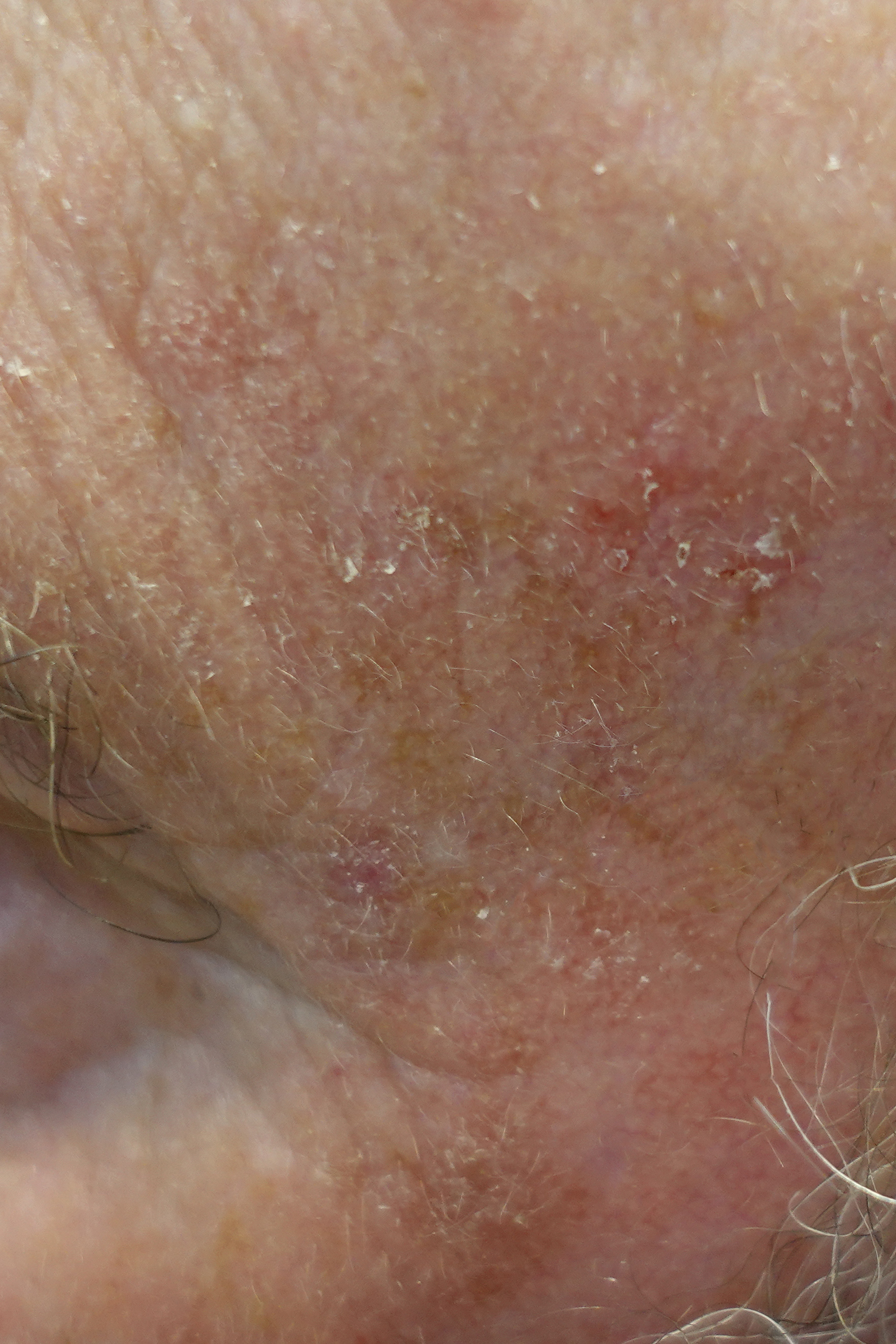 Actinic Keratosis