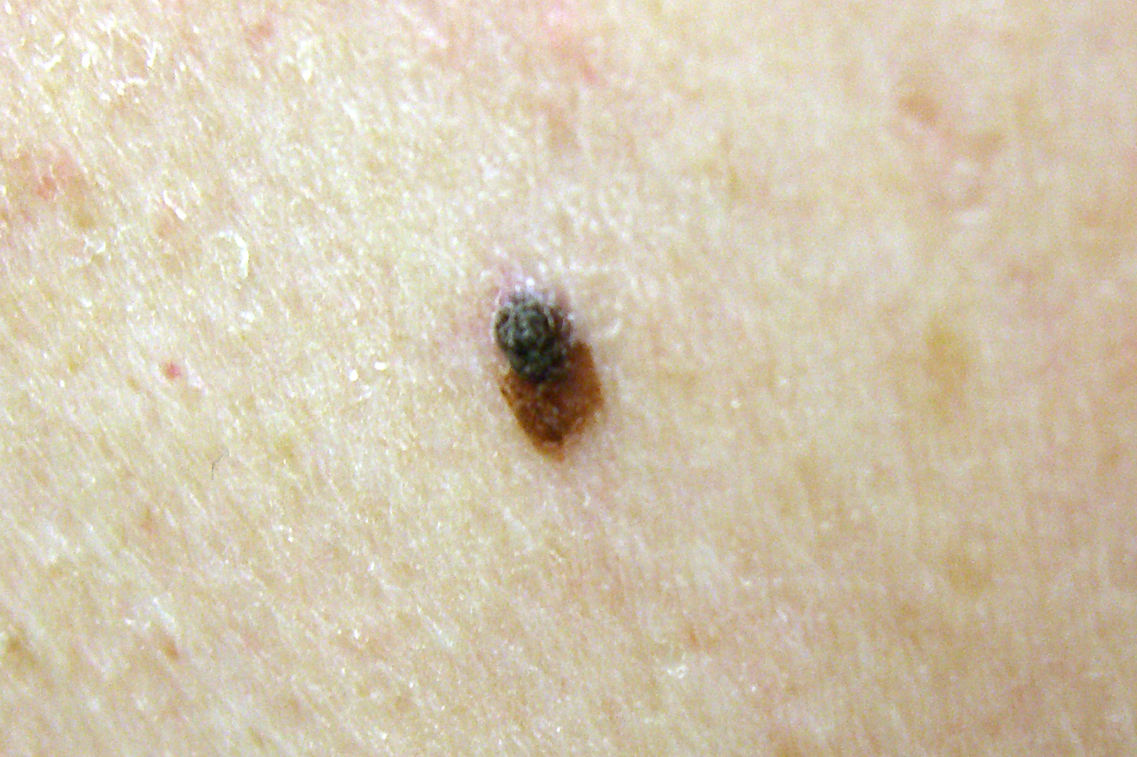 Melanoma